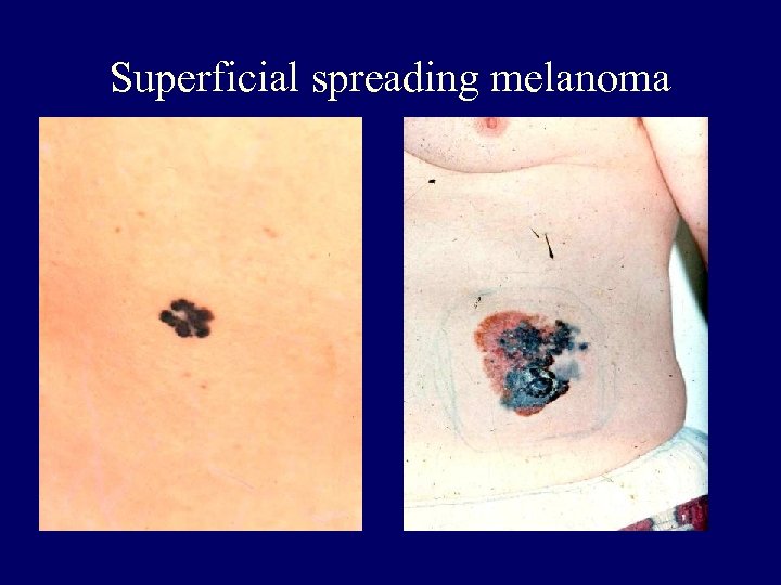 Superficial spreading melanoma 