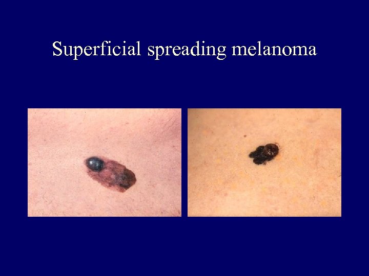 Superficial spreading melanoma 