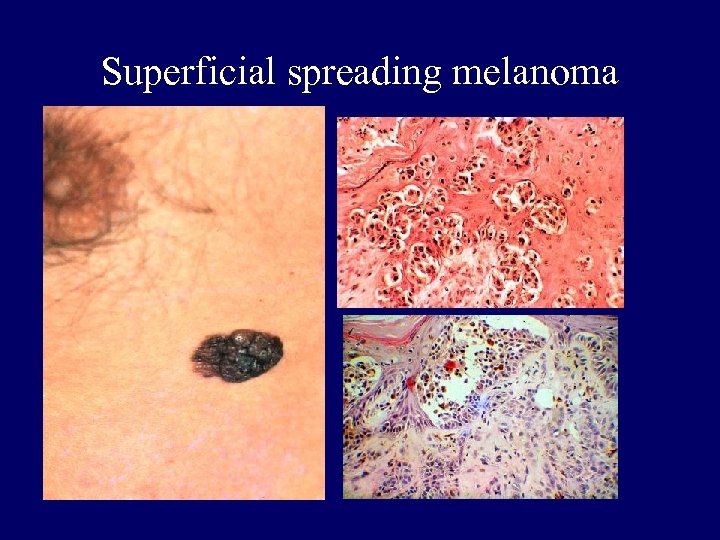 Superficial spreading melanoma 