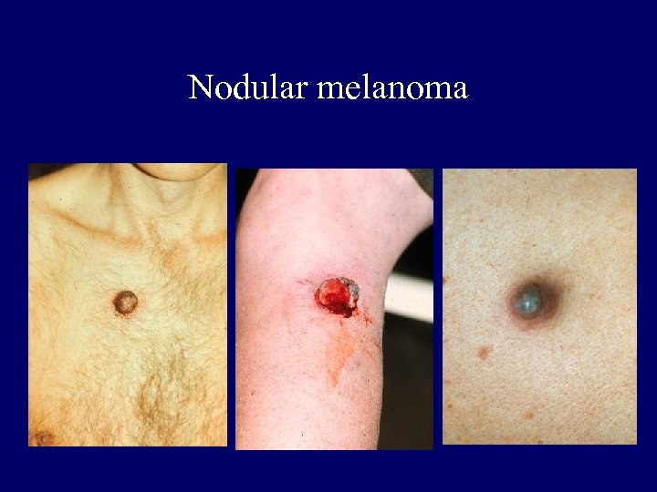 Nodular melanoma 