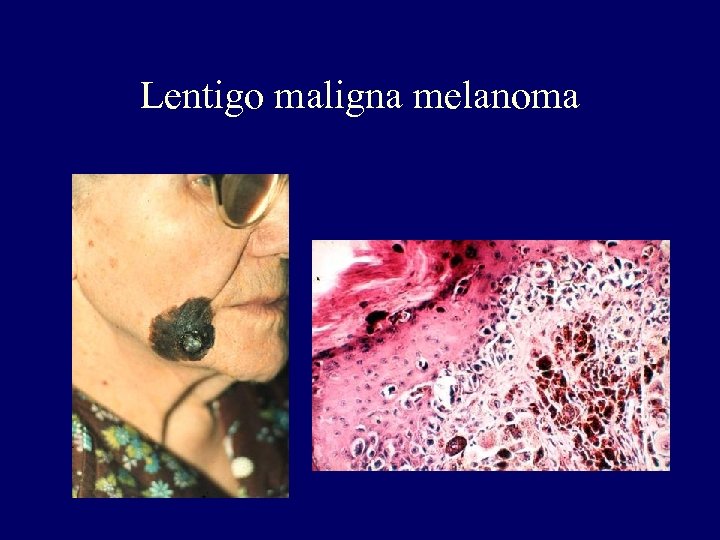 Lentigo maligna melanoma 