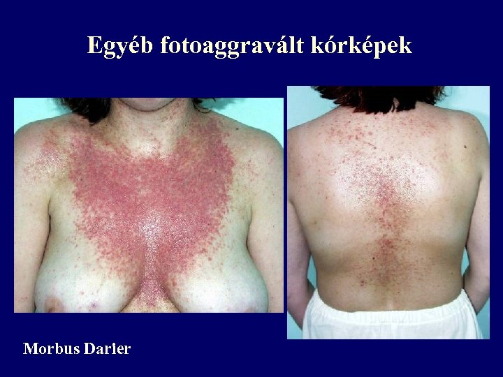 Egyéb fotoaggravált kórképek Morbus Darier 