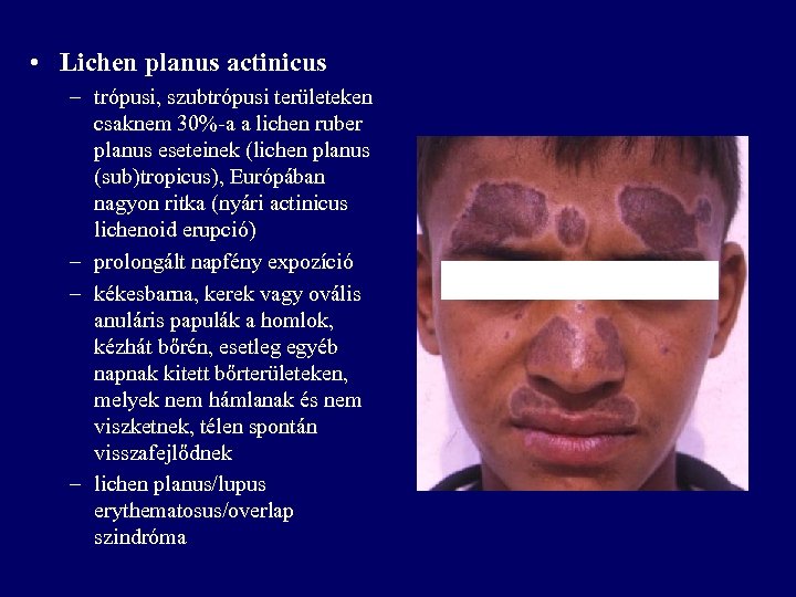  • Lichen planus actinicus – trópusi, szubtrópusi területeken csaknem 30%-a a lichen ruber