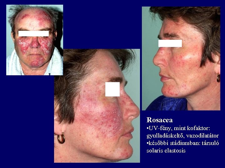 Rosacea • UV-fény, mint kofaktor: gyulladáskeltő, vazodilatátor • későbbi stádiumban: társuló solaris elastosis 