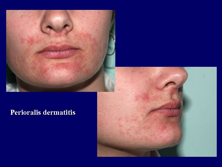 Perioralis dermatitis 