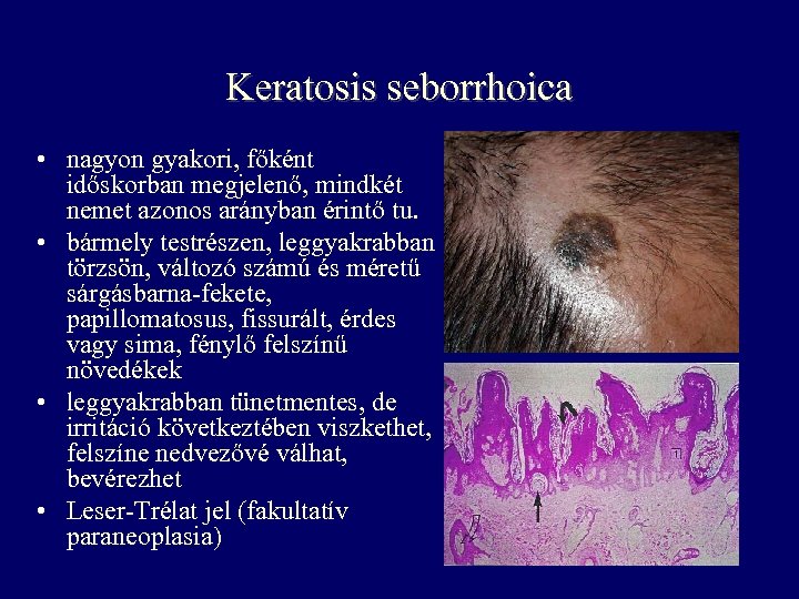 Keratosis seborrhoica • nagyon gyakori, főként időskorban megjelenő, mindkét nemet azonos arányban érintő tu.