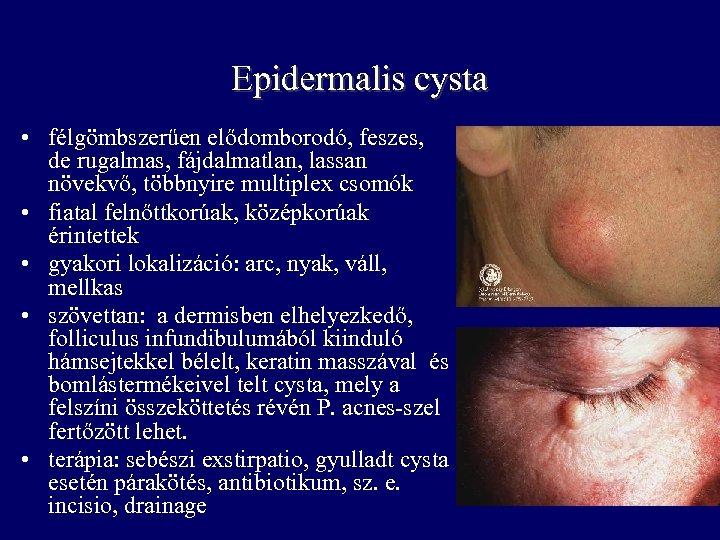 Epidermalis cysta • félgömbszerűen elődomborodó, feszes, de rugalmas, fájdalmatlan, lassan növekvő, többnyire multiplex csomók