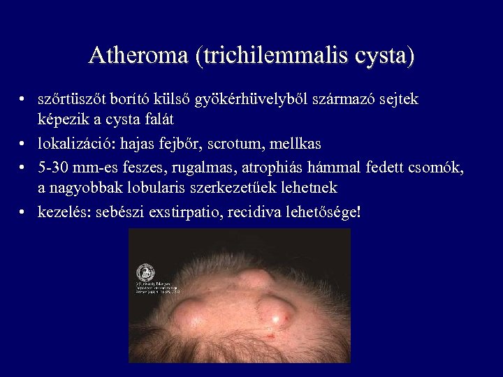 Atheroma (trichilemmalis cysta) • szőrtüszőt borító külső gyökérhüvelyből származó sejtek képezik a cysta falát