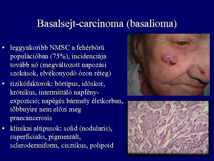 Basalsejt-carcinoma (basalioma) • leggyakoribb NMSC a fehérbőrű populációban (75%), incidenciája tovább nő (megváltozott napozási