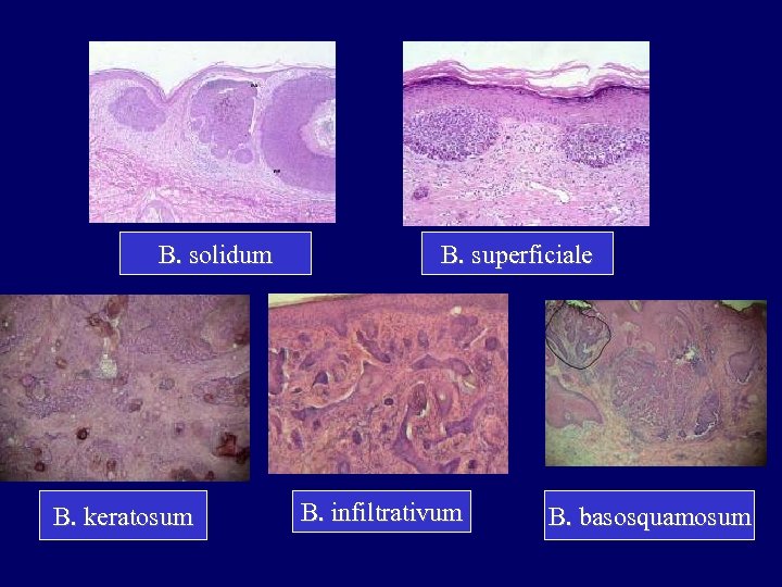 B. solidum B. keratosum B. superficiale B. infiltrativum B. basosquamosum 