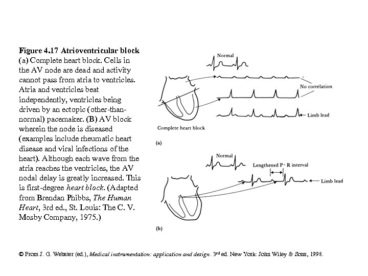 Figure 4. 17 Atrioventricular block (a) Complete heart block. Cells in the AV node