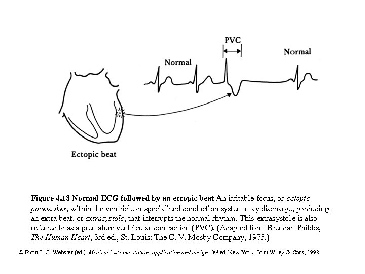 Figure 4. 18 Normal ECG followed by an ectopic beat An irritable focus, or