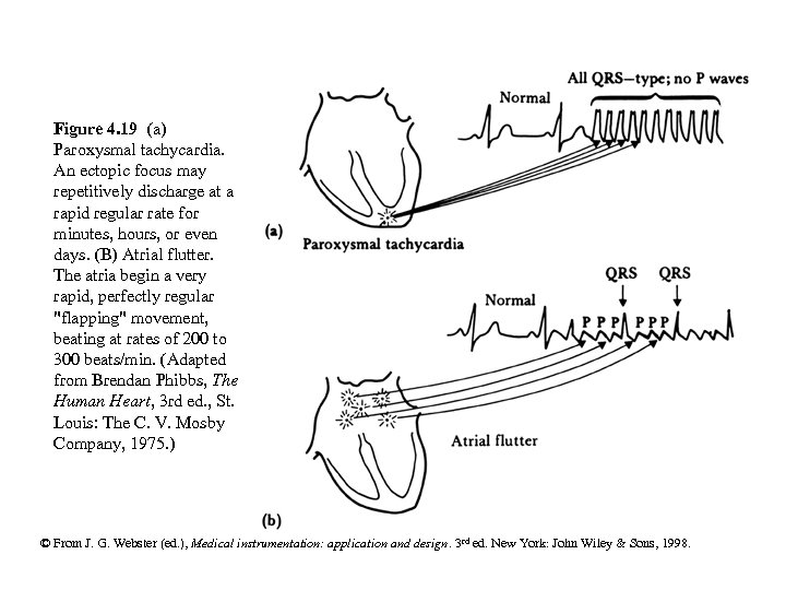 Figure 4. 19 (a) Paroxysmal tachycardia. An ectopic focus may repetitively discharge at a