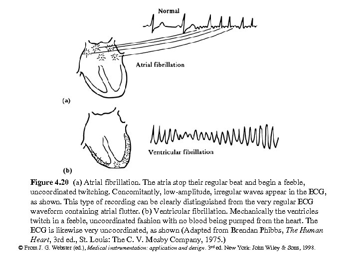 Figure 4. 20 (a) Atrial fibrillation. The atria stop their regular beat and begin