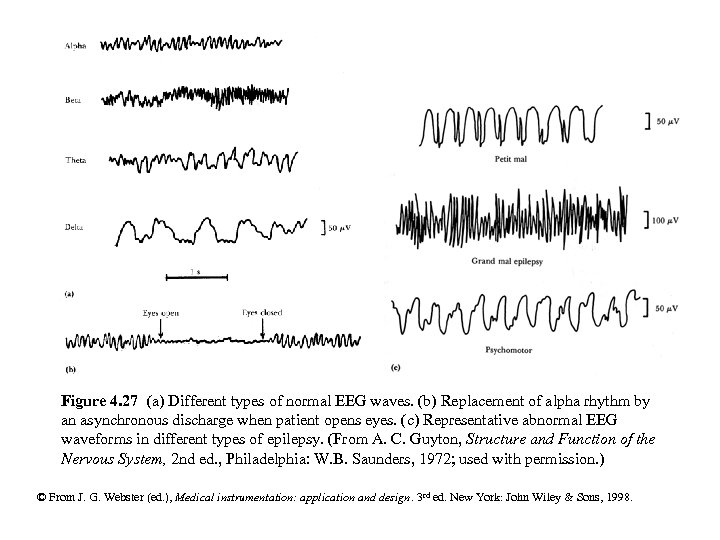 Figure 4. 27 (a) Different types of normal EEG waves. (b) Replacement of alpha