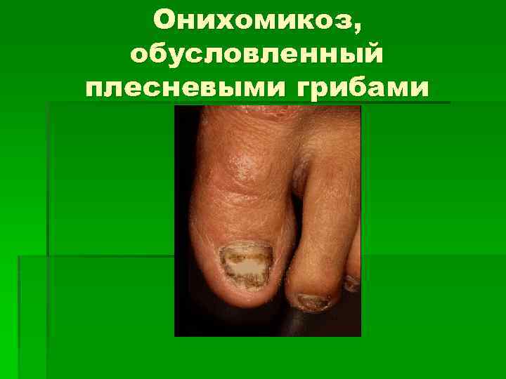 Онихомикоз, обусловленный плесневыми грибами 