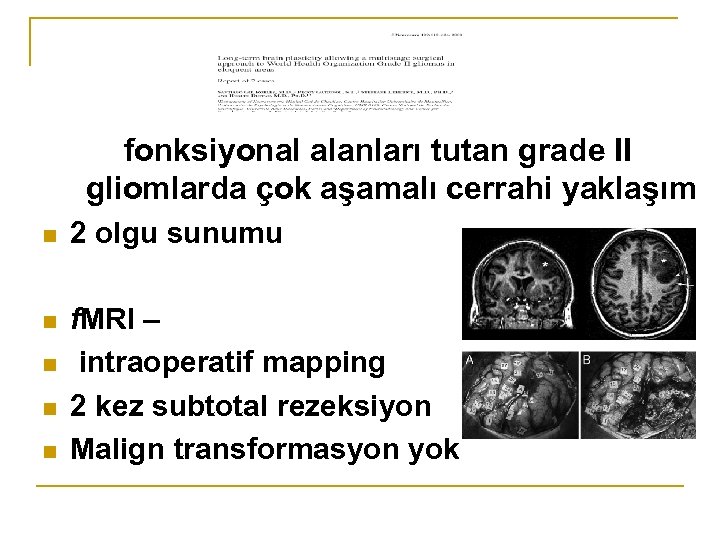 fonksiyonal alanları tutan grade II gliomlarda çok aşamalı cerrahi yaklaşım n 2 olgu sunumu