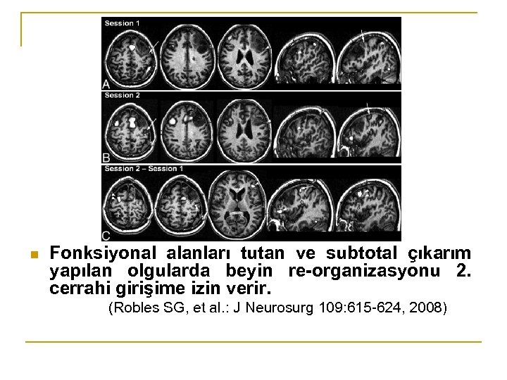 n Fonksiyonal alanları tutan ve subtotal çıkarım yapılan olgularda beyin re-organizasyonu 2. cerrahi girişime