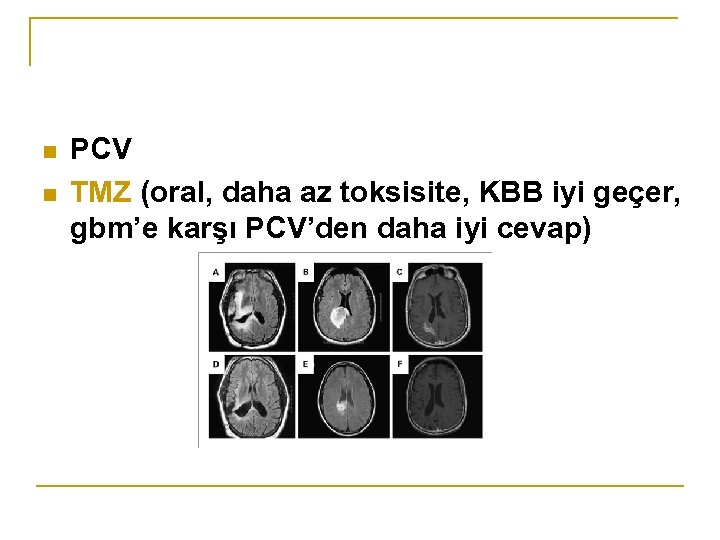 n n PCV TMZ (oral, daha az toksisite, KBB iyi geçer, gbm’e karşı PCV’den