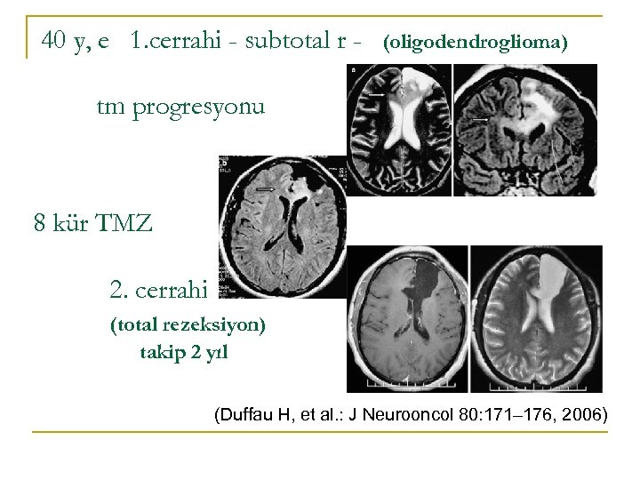 40 y, e 1. cerrahi - subtotal r - (oligodendroglioma) tm progresyonu 8 kür