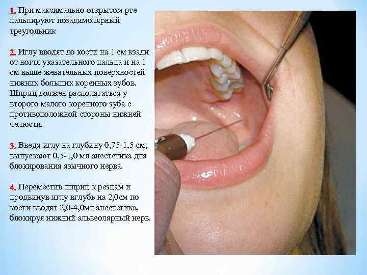При максимально открытом рте пальпируют позадимолярный треугольник Иглу вводят до кости на 1 см