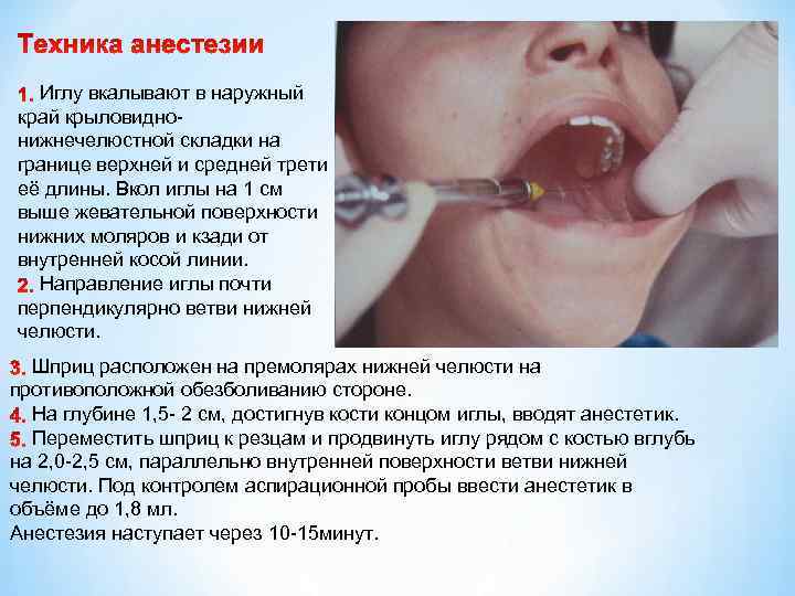 Иглу вкалывают в наружный край крыловиднонижнечелюстной складки на границе верхней и средней трети её