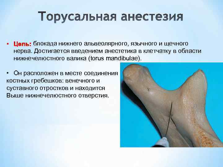 блокада нижнего альвеолярного, язычного и щечного нерва. Достигается введением анестетика в клетчатку в области