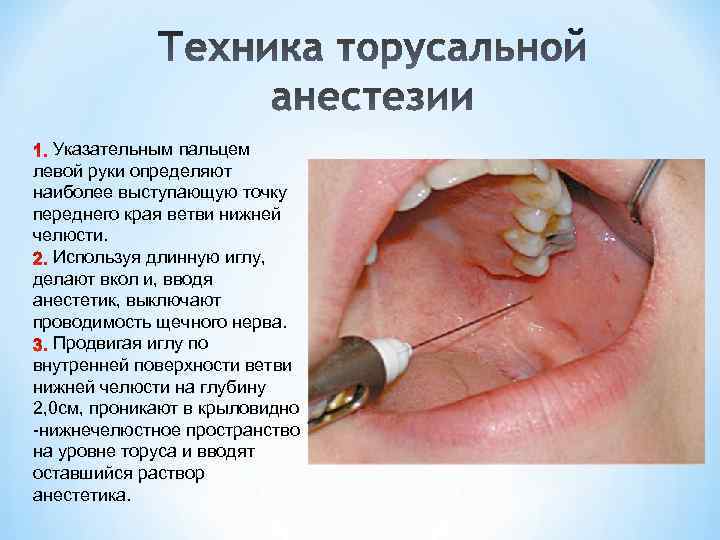 Указательным пальцем левой руки определяют наиболее выступающую точку переднего края ветви нижней челюсти. Используя