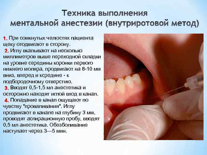 При сомкнутых челюстях пациента щеку отодвигают в сторону. Иглу вкалывают на несколько миллиметров выше