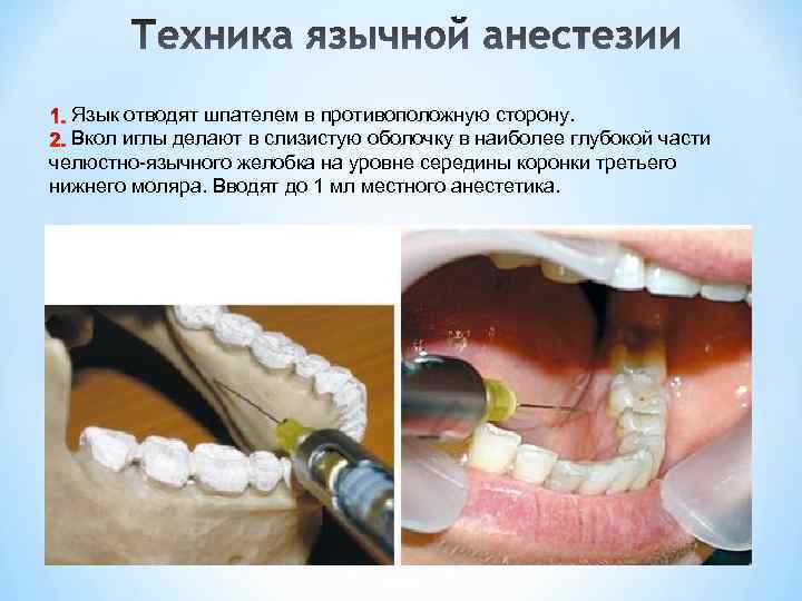 Язык отводят шпателем в противоположную сторону. Вкол иглы делают в слизистую оболочку в наиболее