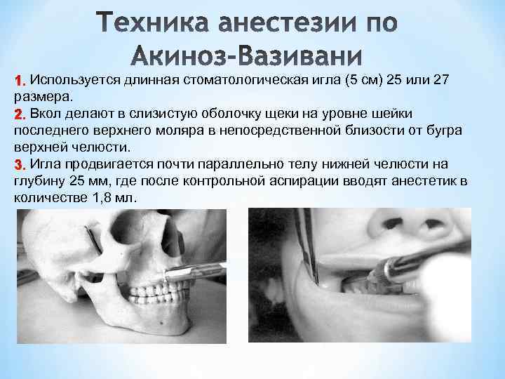 Используется длинная стоматологическая игла (5 см) 25 или 27 размера. Вкол делают в слизистую