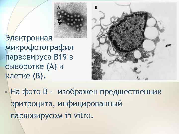 Электронная микрофотография парвовируса В 19 в сыворотке (А) и клетке (В). • На фото