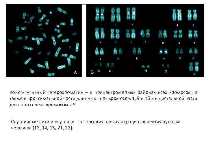 20 хромосом. Спутничные хромосомы у человека. Спутничные хромосомы в кариотипе человека. Конститутивный кариотип. Прицентромерный гетерохроматин.