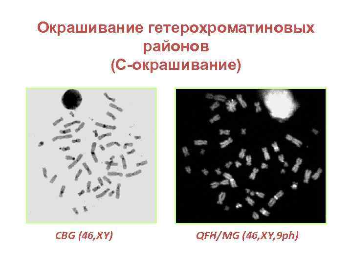 Окрашивание гетерохроматиновых районов (С-окрашивание) CBG (46, XY) QFH/MG (46, XY, 9 ph) 