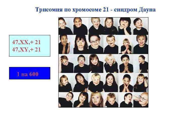 Трисомия по хромосоме 21 - синдром Дауна 47, XX, + 21 47, XY, +