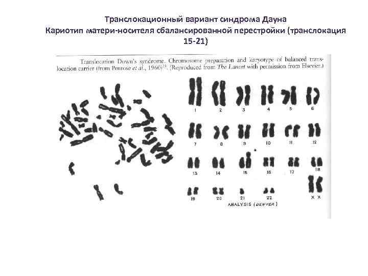 Кариотип синдрома дауна. Транслокационный синдром Дауна кариотип. Транслокационная форма синдрома Дауна. Кариотип Дауна транслокационная форма. Транслокационный вариант синдрома Дауна кариотип.