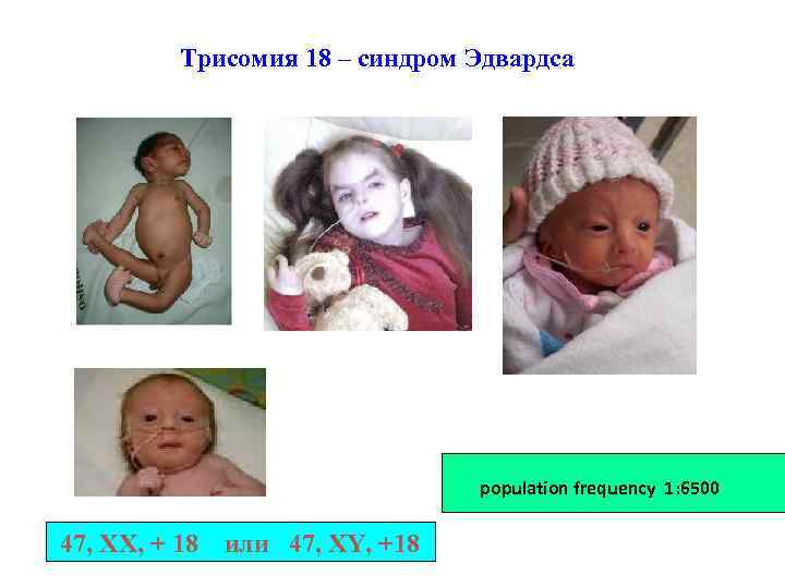 Трисомия 18 – синдром Эдвардса population frequency 1: 6500 47, XX, + 18 или