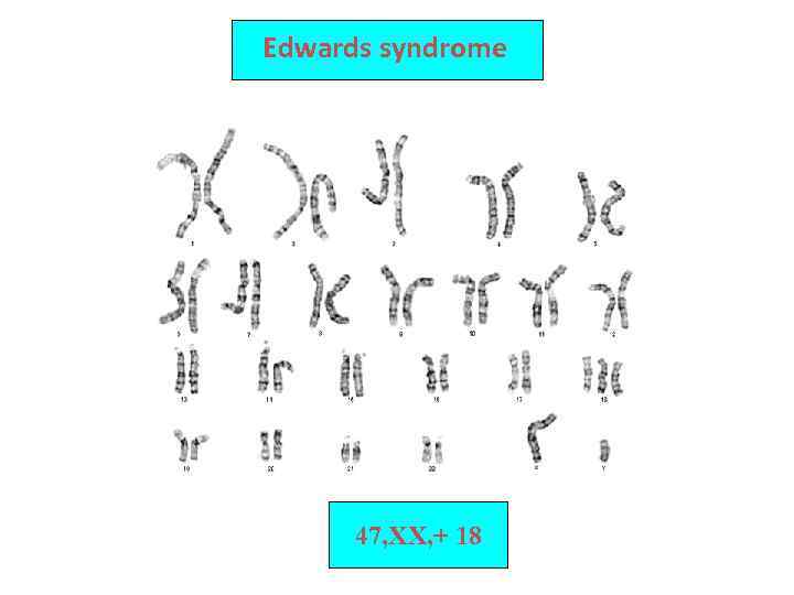 Edwards syndrome 47, XX, + 18 