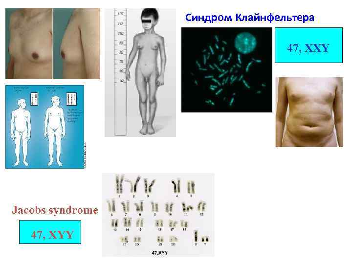 Синдром Клайнфельтера 47, XXY Jacobs syndrome 47, XYY 