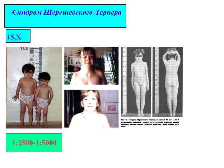 Синдром Шерешевского-Тернера 45, Х 1: 2500 -1: 5000 
