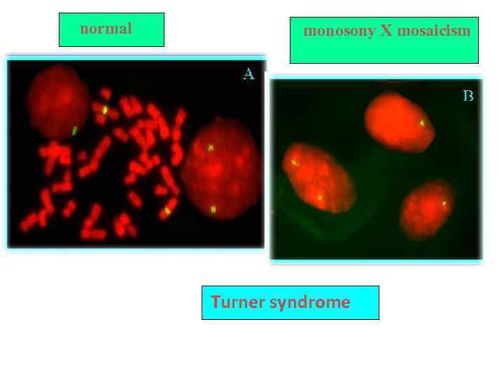 normal monosony Х mosaicism Turner syndrome 