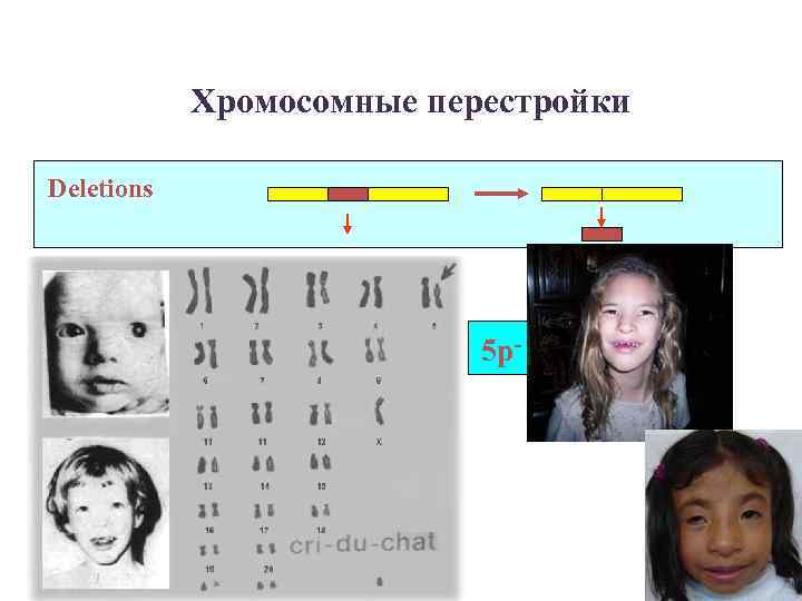 Хромосомные перестройки Deletions 5 p- 
