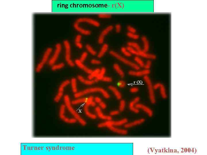 ring chromosome- r(X) Turner syndrome (Vyatkina, 2004) 