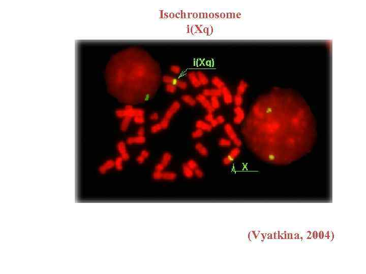 Isochromosome i(Xq) (Vyatkina, 2004) 