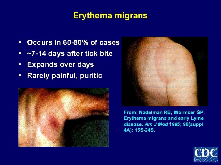 Erythema migrans • • Occurs in 60 -80% of cases ~7 -14 days after