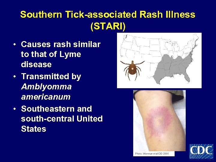 Southern Tick-associated Rash Illness (STARI) • Causes rash similar to that of Lyme disease