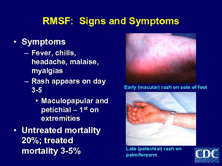 RMSF: Signs and Symptoms • Symptoms – Fever, chills, headache, malaise, myalgias – Rash