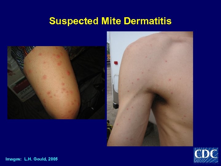 Suspected Mite Dermatitis Images: L. H. Gould, 2005 