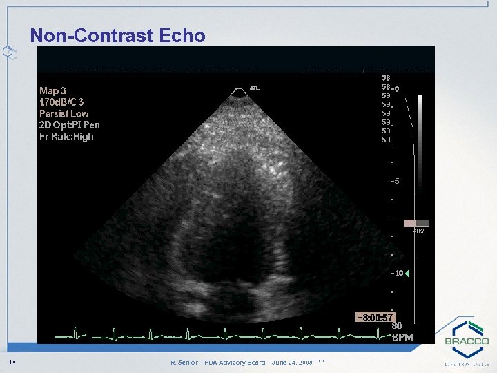 Non-Contrast Echo 10 R. Senior – FDA Advisory Board – June 24, 2008 *