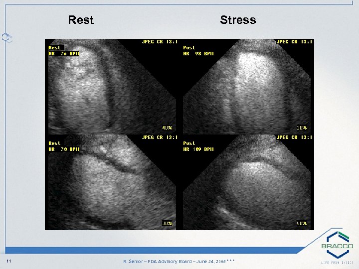 Rest 11 Stress R. Senior – FDA Advisory Board – June 24, 2008 *